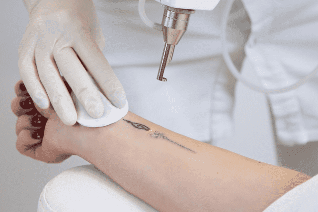 Did You Dream About… Tattoo Removal