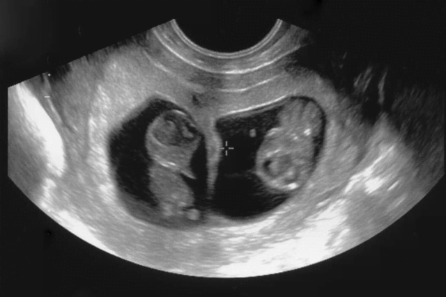 Did You Dream About… a Twins Ultrasound